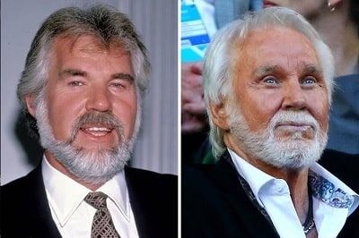 A picture of Kenny Rogers before (left) and after (right).